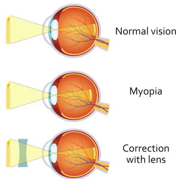 What is Myopia and What are its Types