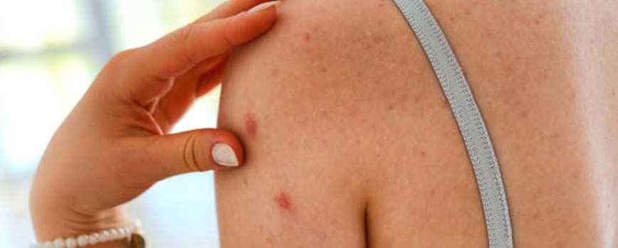 Back Acne Types, Causes, and How to Prevent It