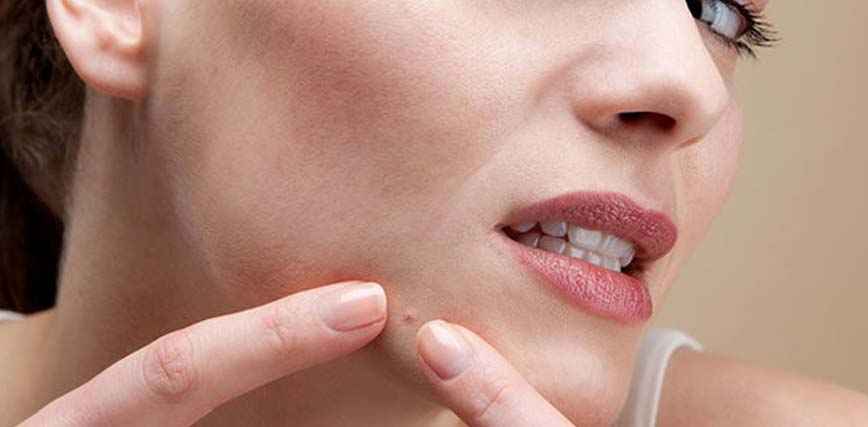 Fungal Acne: What are the Symptoms & How To Treat It?